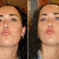 Retoque facial